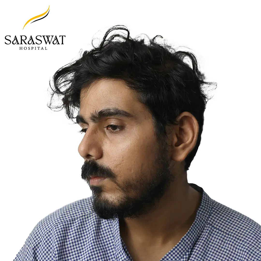 45 Degree Left FUE Hair Transplant Result Before Procedure