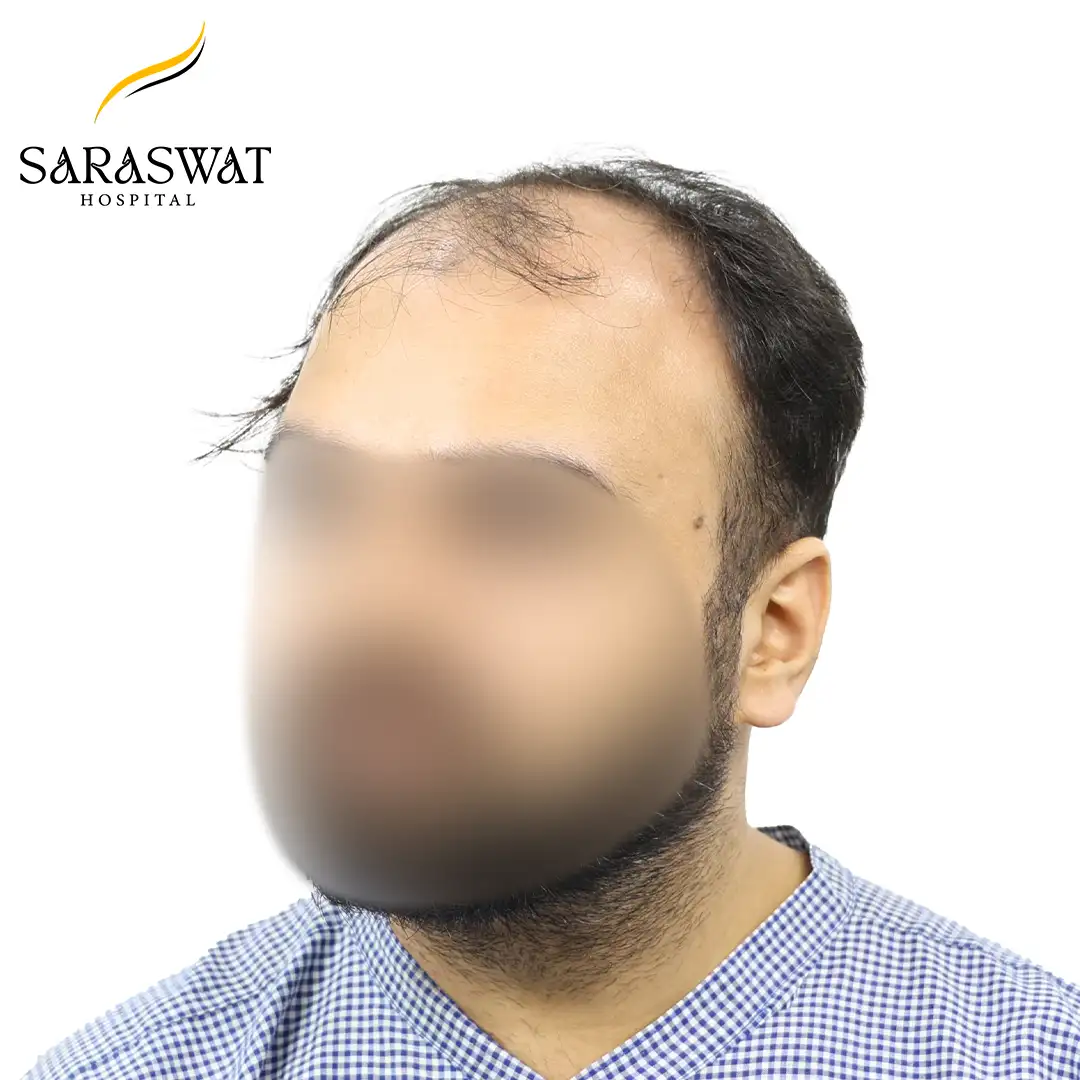 45 Degree Left FUE Hair Transplant Result Before Procedure