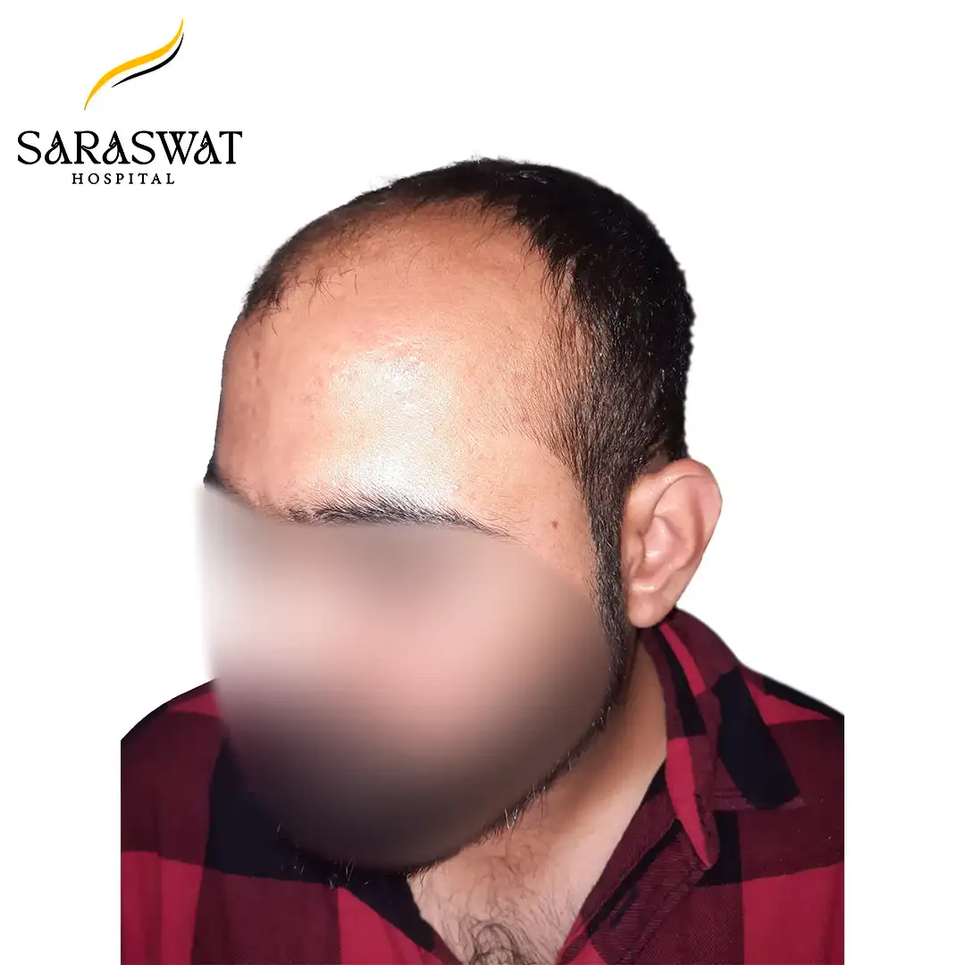 Hair Transplant Before and After Result