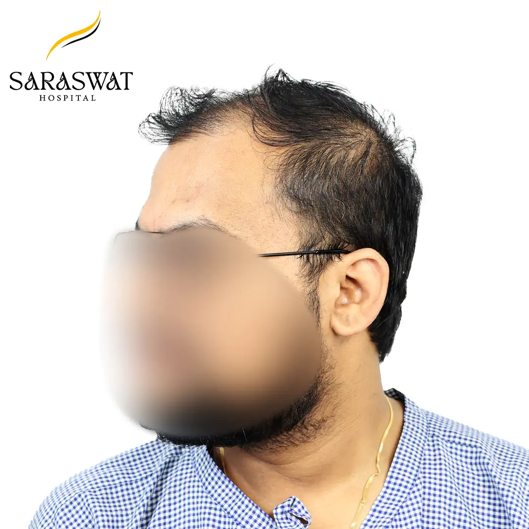 90 Degree Left FUE Hair Transplant Result Before Procedure