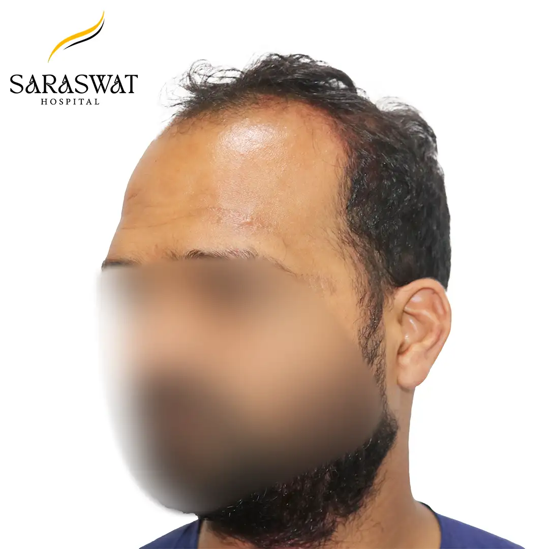 45 Degree Left FUE Hair Transplant Result Before Procedure