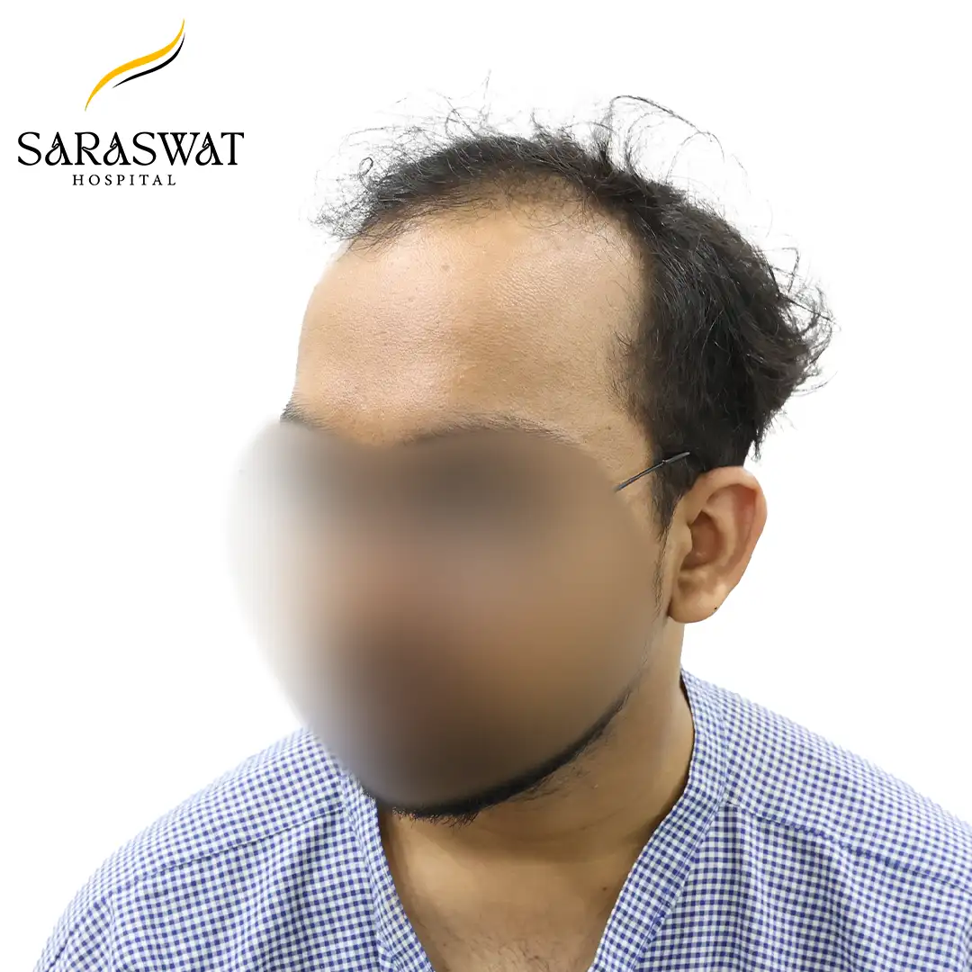 45 Degree Left FUE Hair Transplant Result Before Procedure