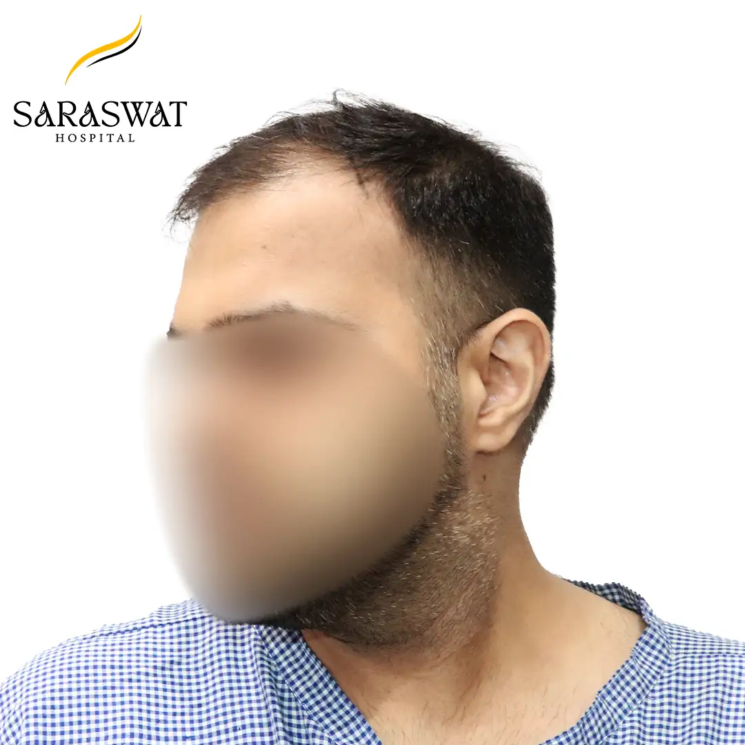 45 Degree Left FUE Hair Transplant Result Before Procedure