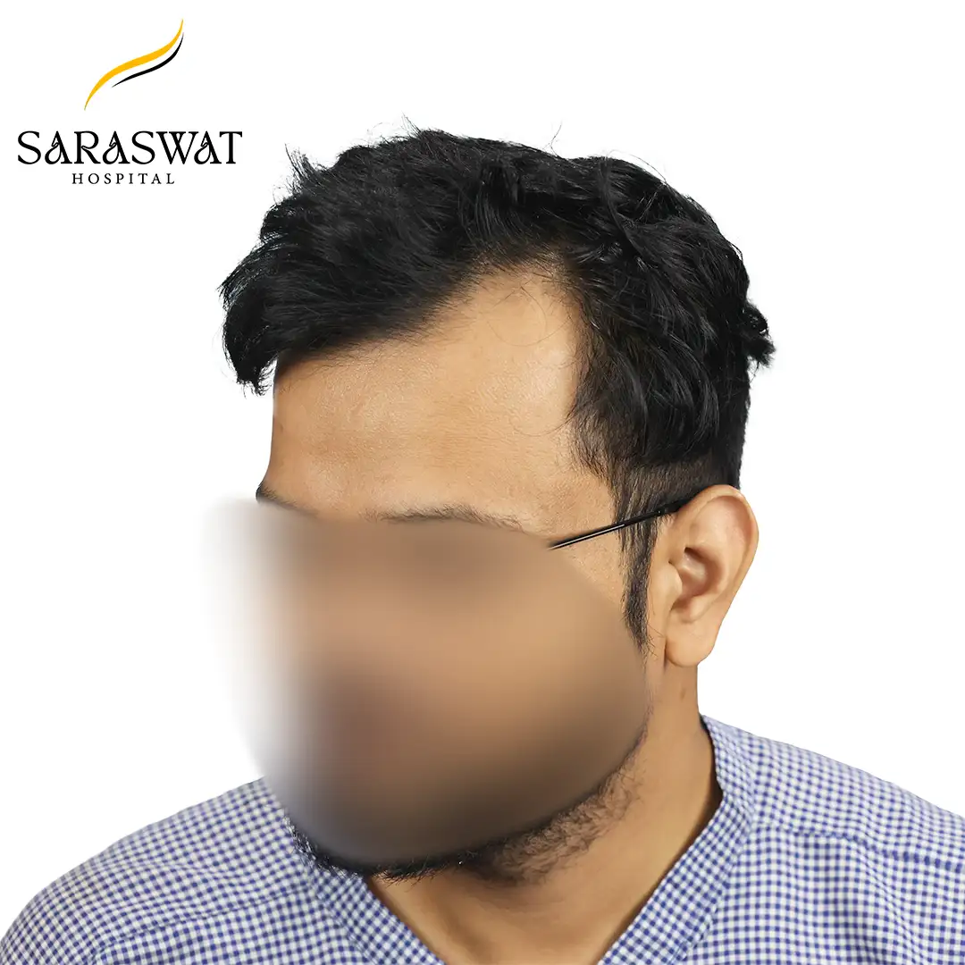 45 Degree Left FUE Hair Transplant Result Before Procedure