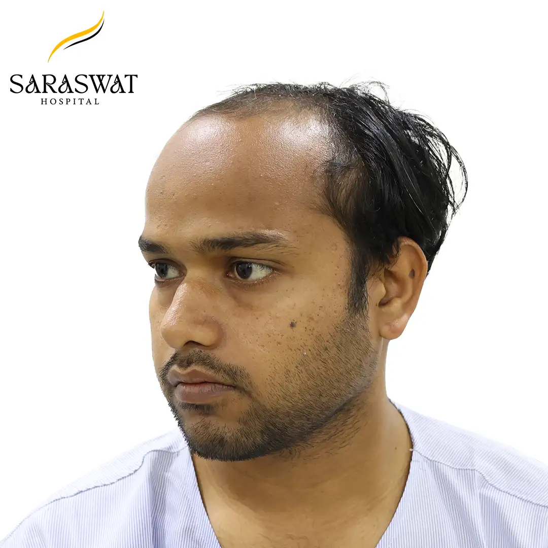 45 Degree Left FUE Hair Transplant Result Before Procedure