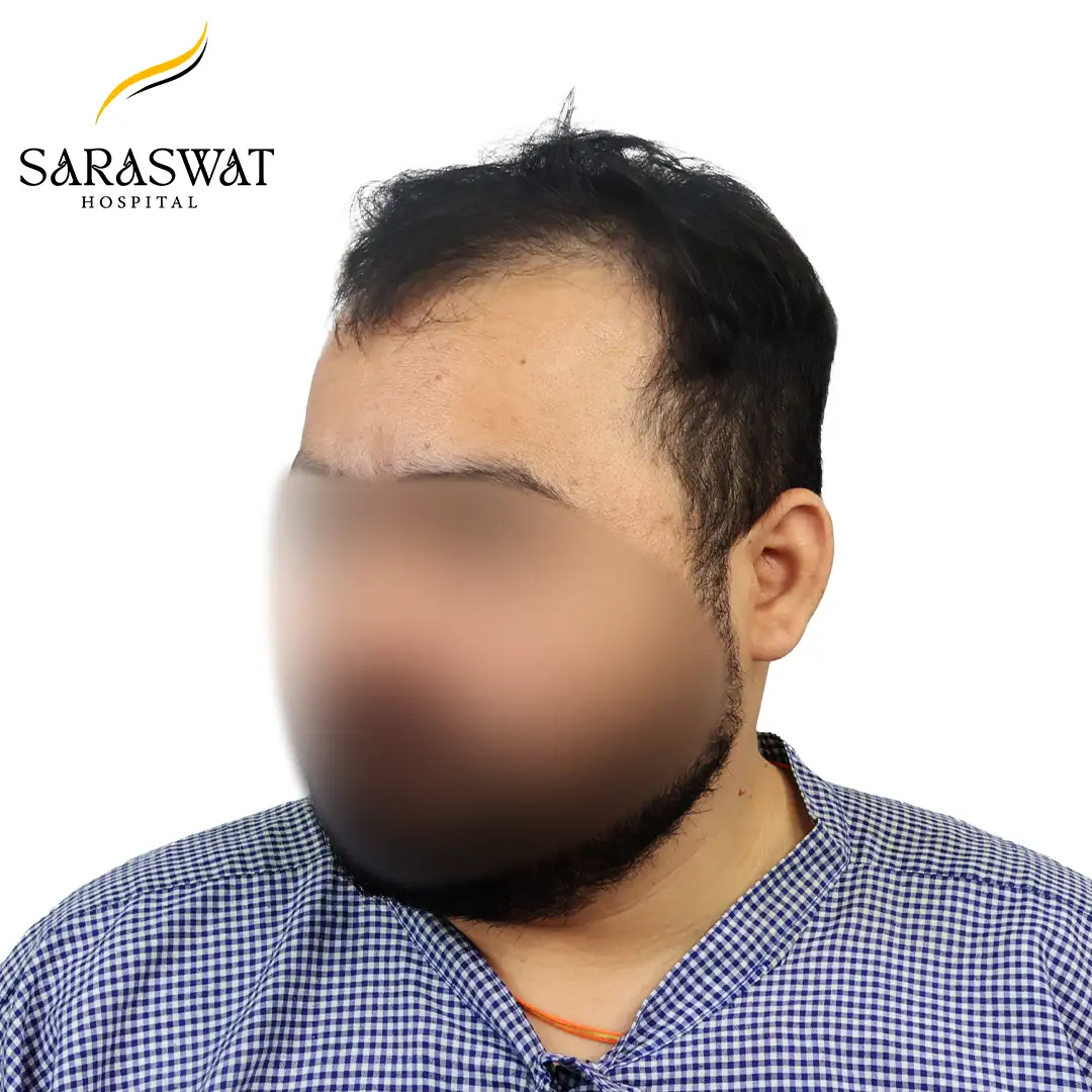 45 Degree Left FUE Hair Transplant Result Before Procedure