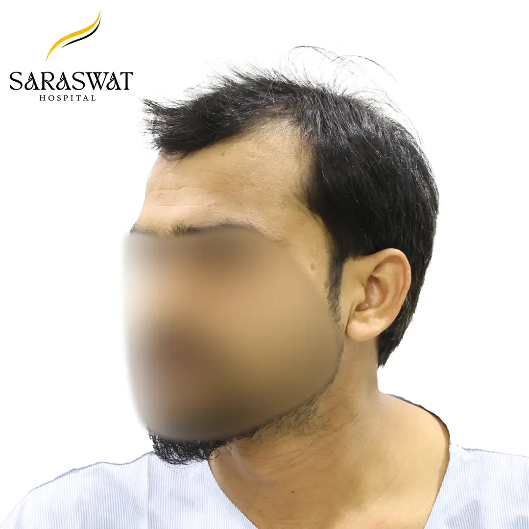 45 Degree Left FUE Hair Transplant Result Before Procedure