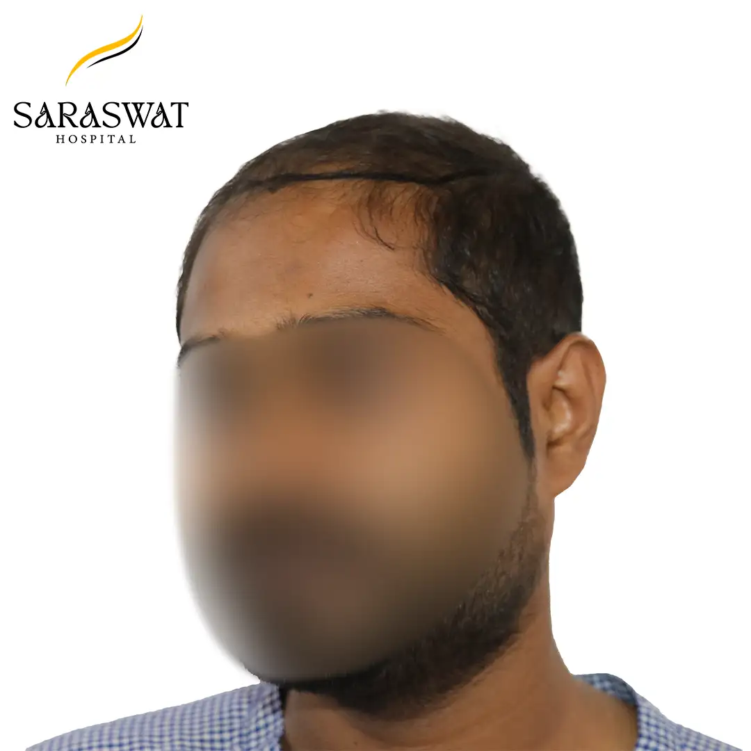 45 Degree Left FUE Hair Transplant Result Before Procedure