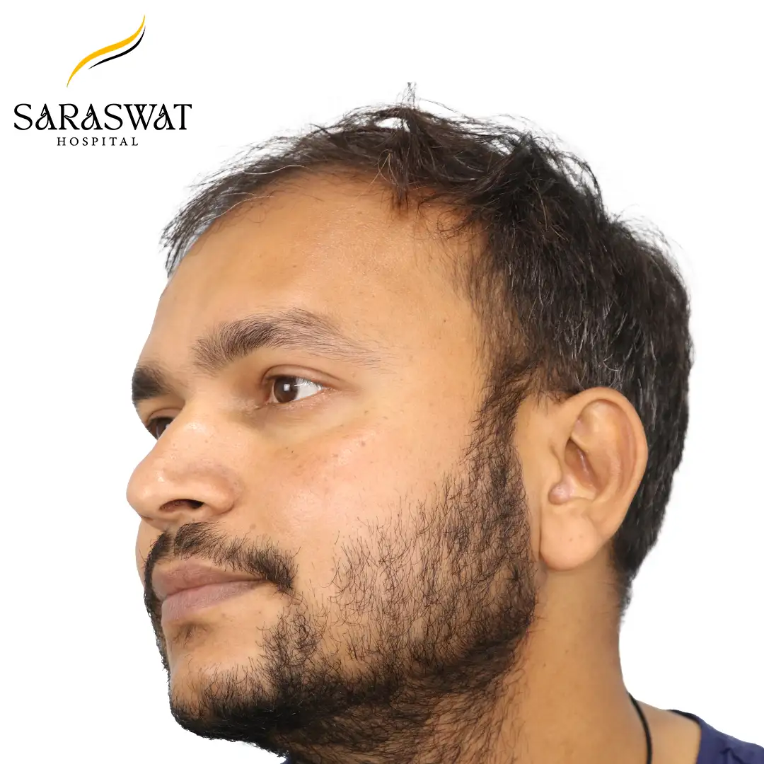 45 Degree Left FUE Hair Transplant Result Before Procedure