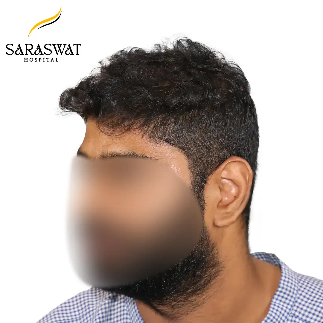 45 Degree FUE Hair Transplant Result Before Procedure