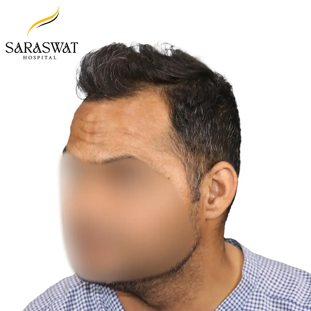45 Degree Left FUE Hair Transplant Result Before Procedure