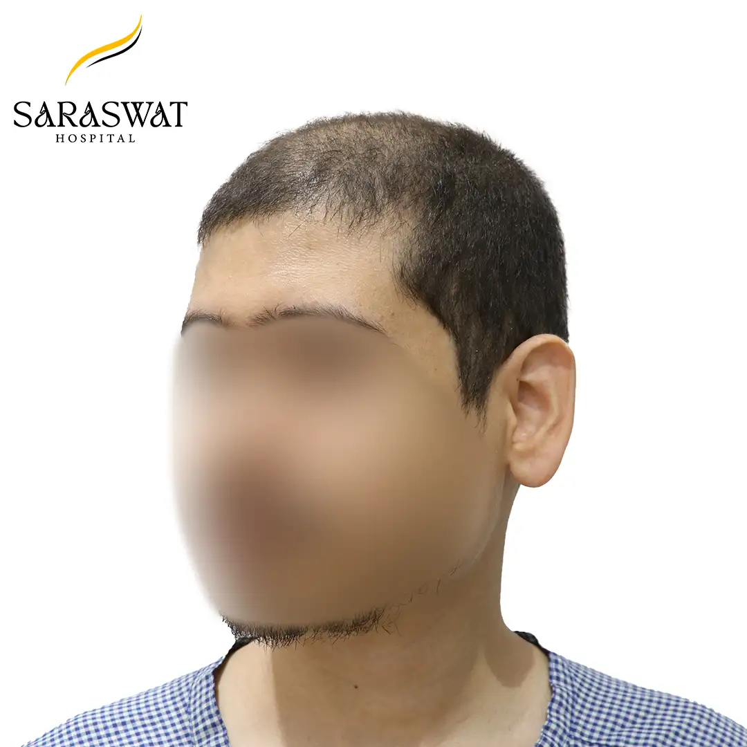 Hair Transplant Cost