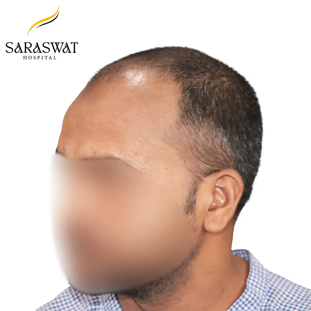 45 Degree Left FUE Hair Transplant Result Before Procedure