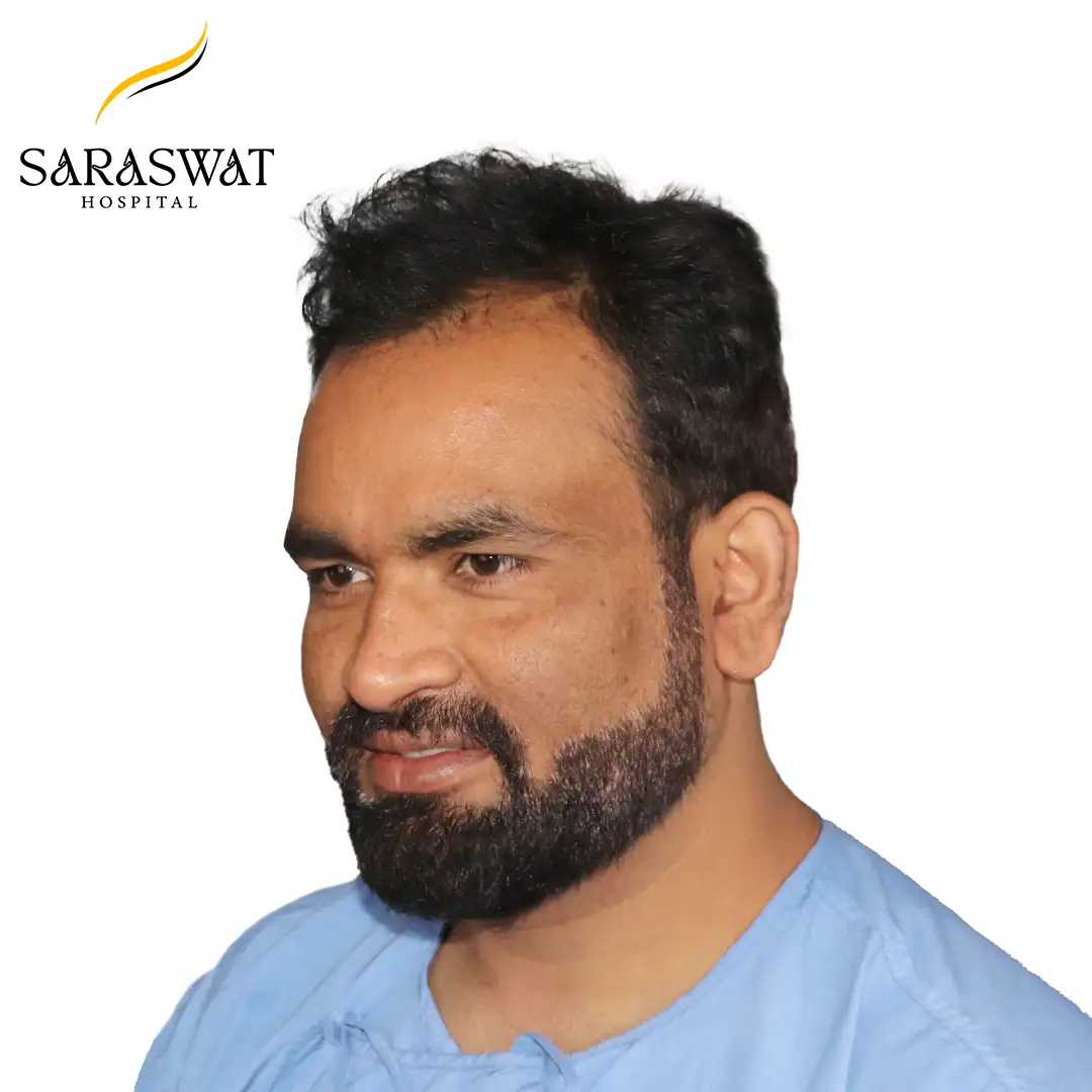 45 Degree Left FUE Hair Transplant Result Before Procedure