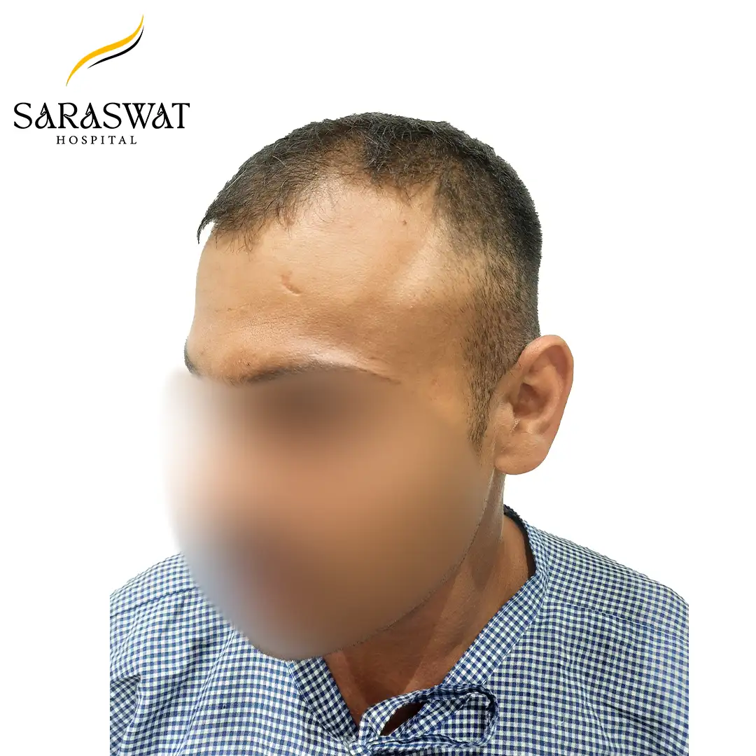 45 Degree Left FUE Hair Transplant Result Before Procedure