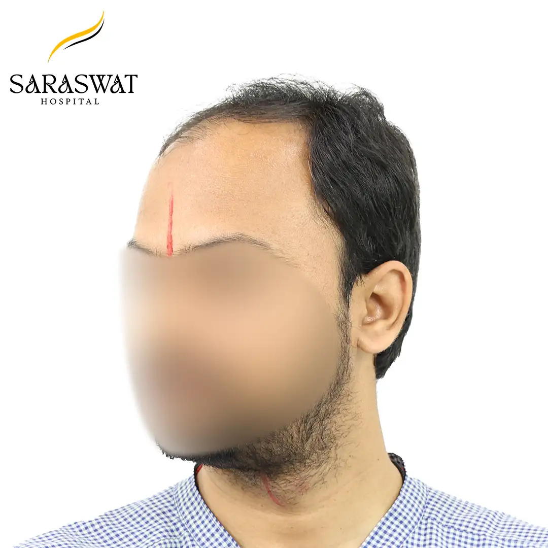 45 Degree Left FUE Hair Transplant Result Before Procedure