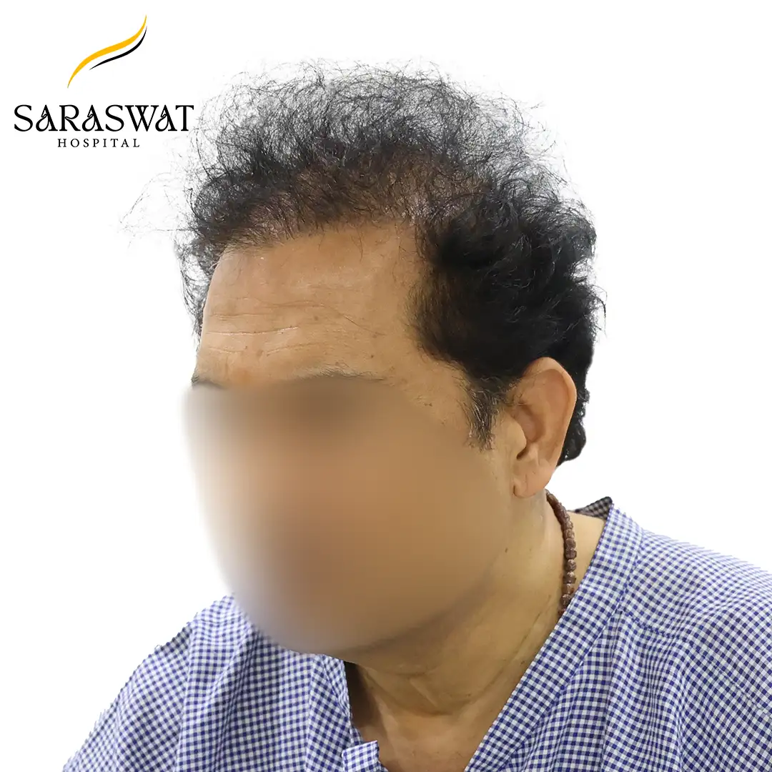 Hair Transplant Result