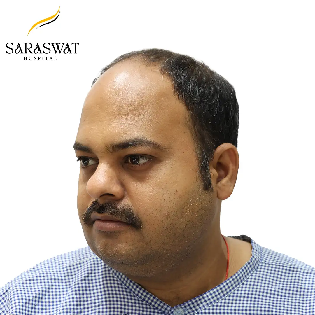 45 Degree Left FUE Hair Transplant Result Before Procedure