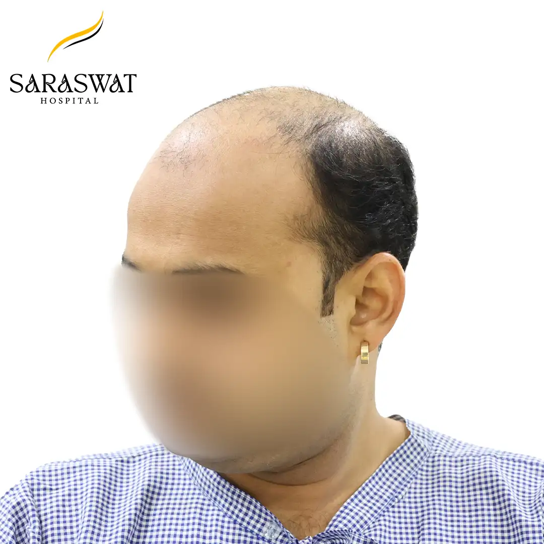45 Degree Left FUE Hair Transplant Result Before Procedure