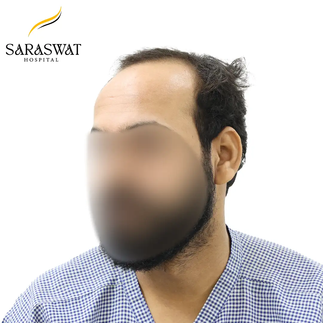 45 Degree Left FUE Hair Transplant Result Before Procedure