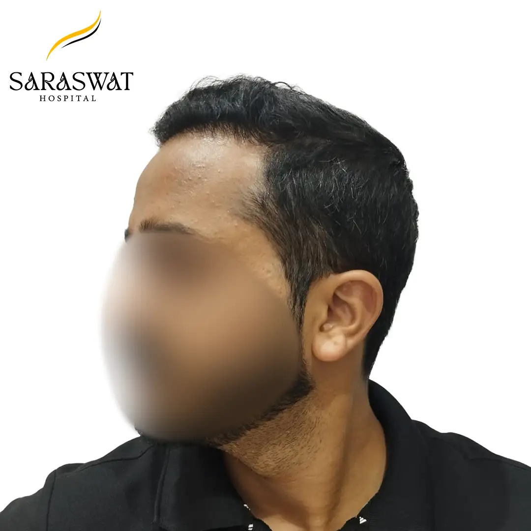 90 Degree Left FUE Hair Transplant Result After Procedure
