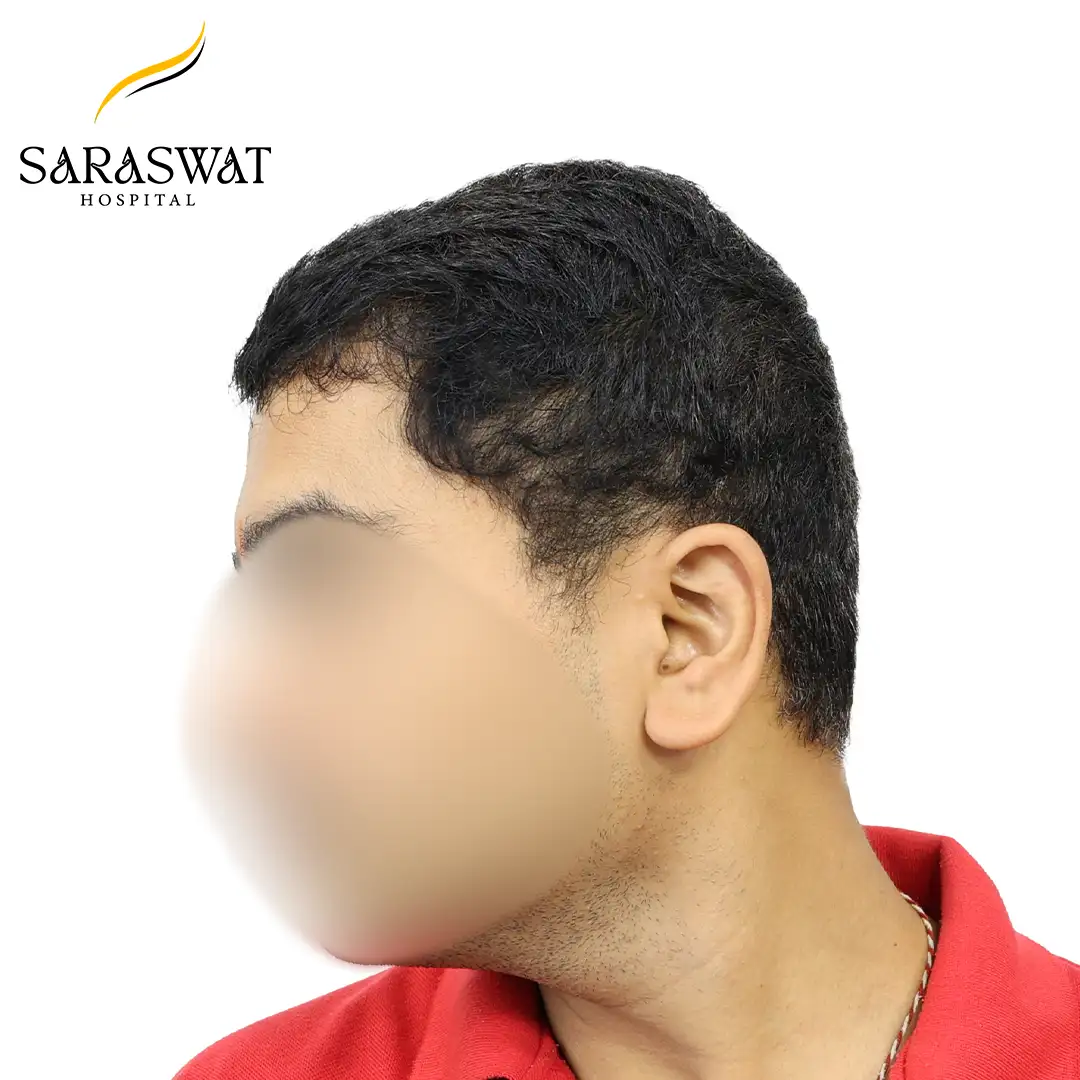 90 Degree Left FUE Hair Transplant Result After Procedure