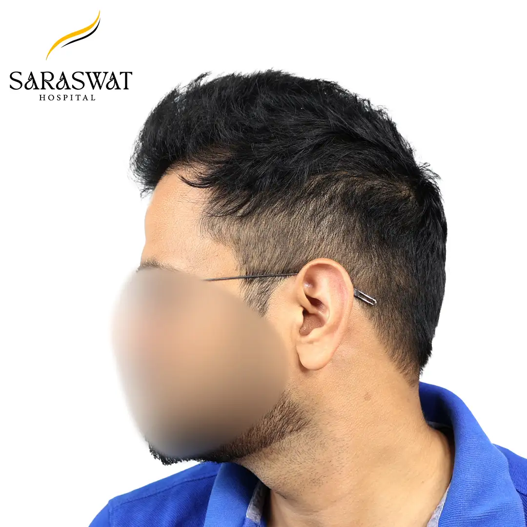 90 Degree Left FUE Hair Transplant Result After Procedure