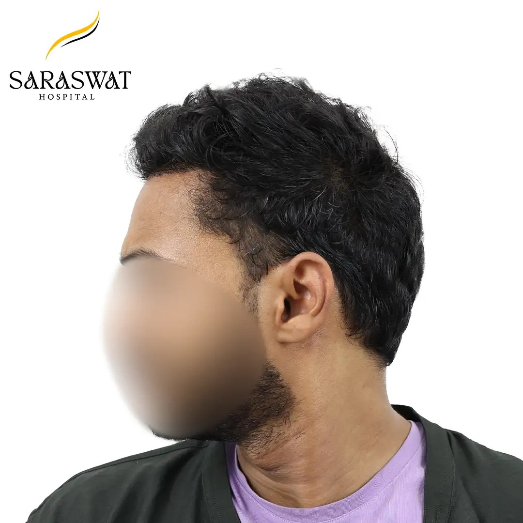 90 Degree Left FUE Hair Transplant Result After Procedure