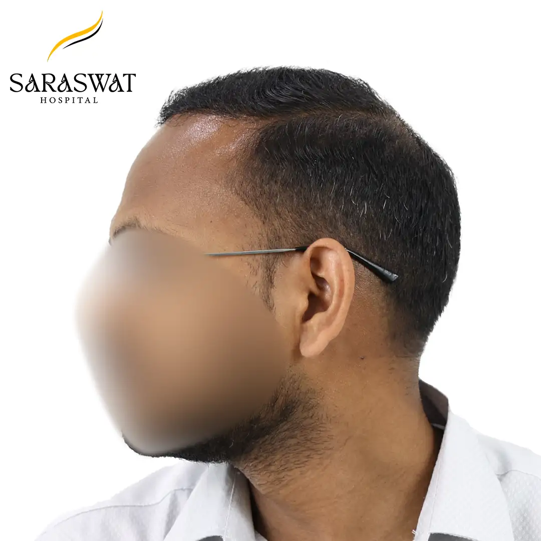 Hair Transplant Before and After Results