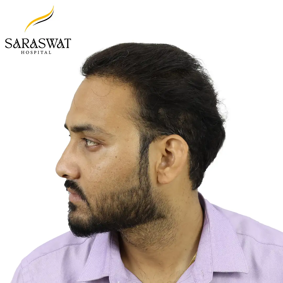 90 Degree Left FUE Hair Transplant Result After Procedure