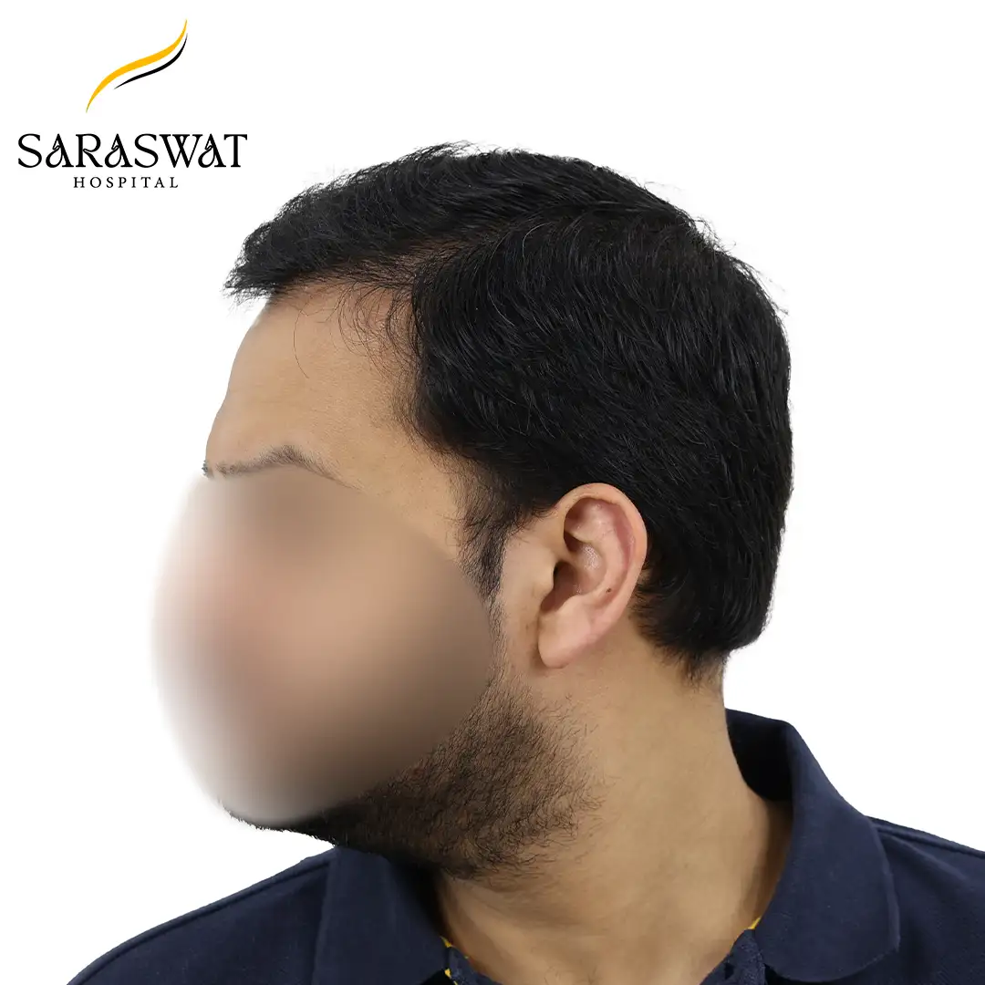 90 Degree Left FUE Hair Transplant Result After Procedure