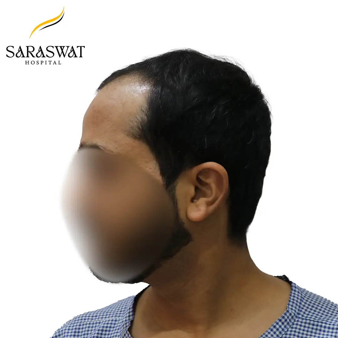 90 Degree Left FUE Hair Transplant Result Before Procedure