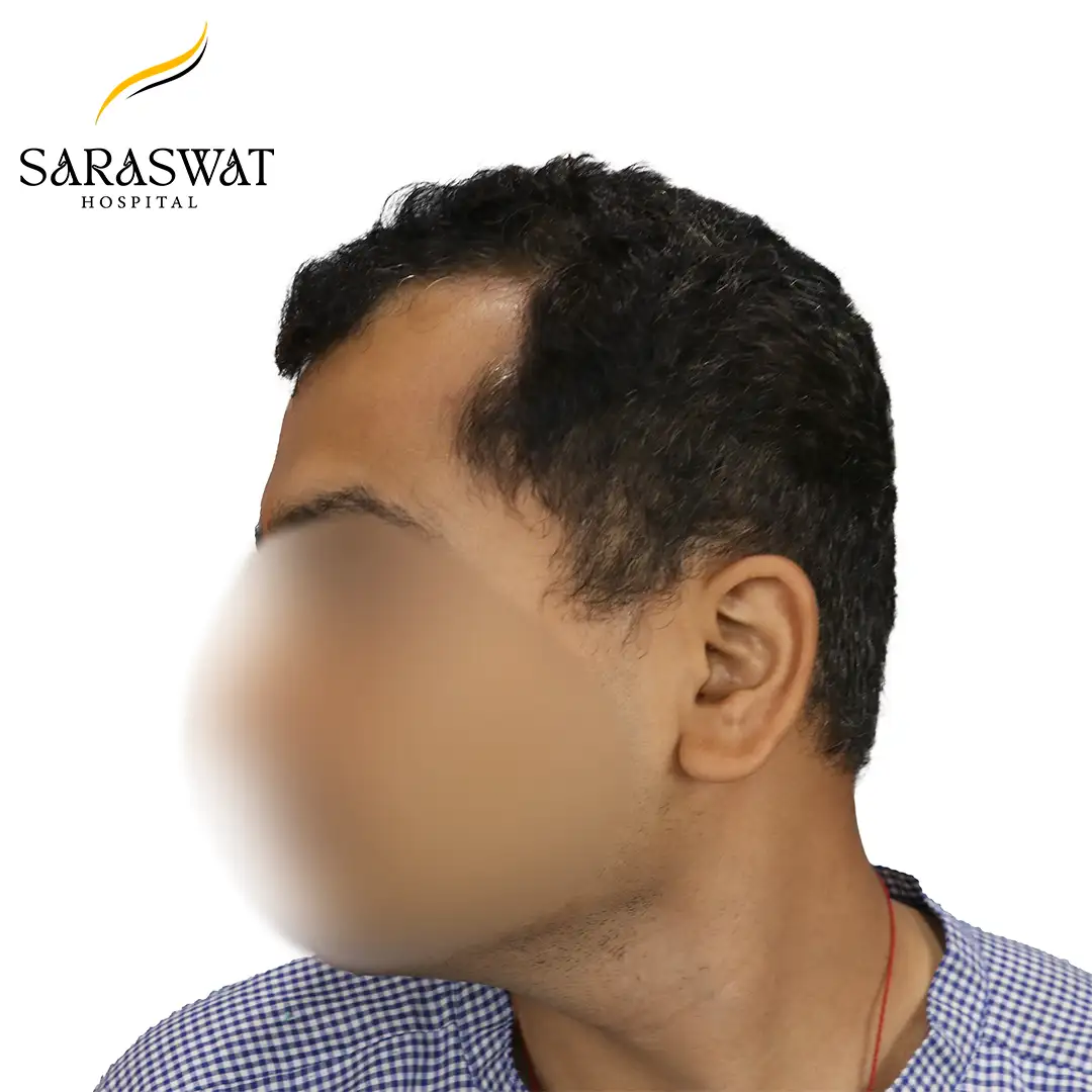 90 Degree Left FUE Hair Transplant Result Before Procedure