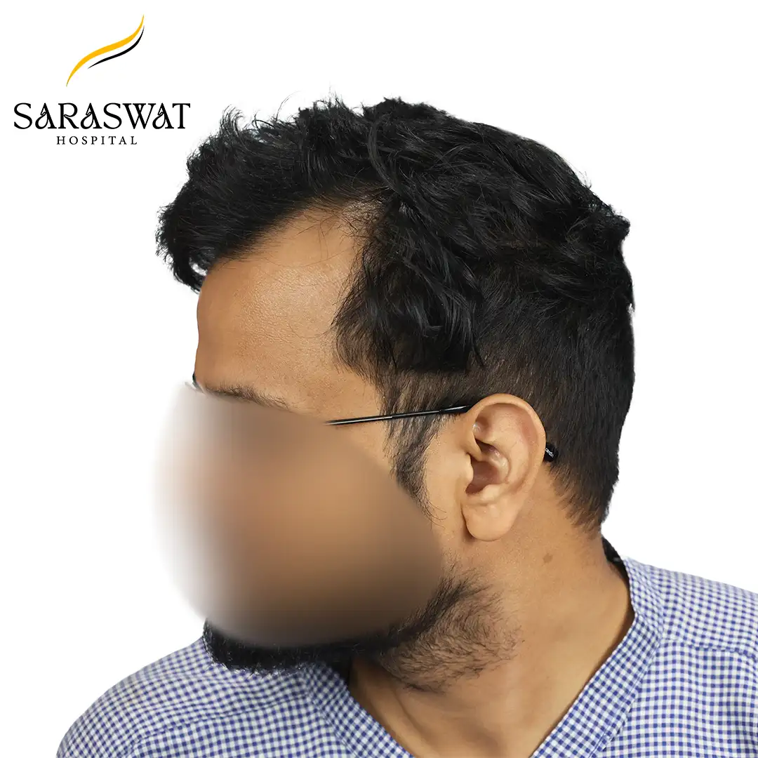 90 Degree Left FUE Hair Transplant Result Before Procedure
