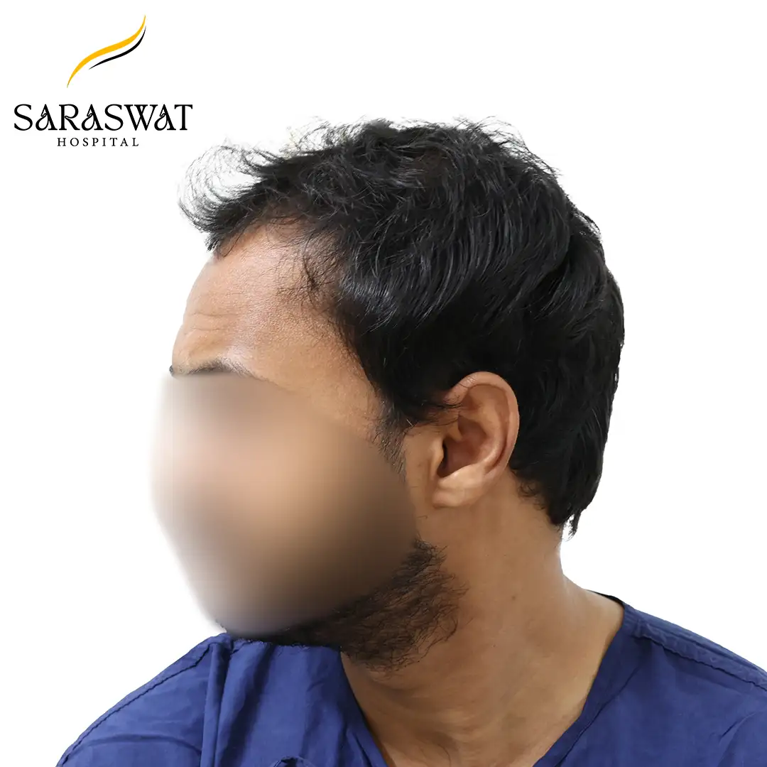 90 Degree Left FUE Hair Transplant Result Before Procedure