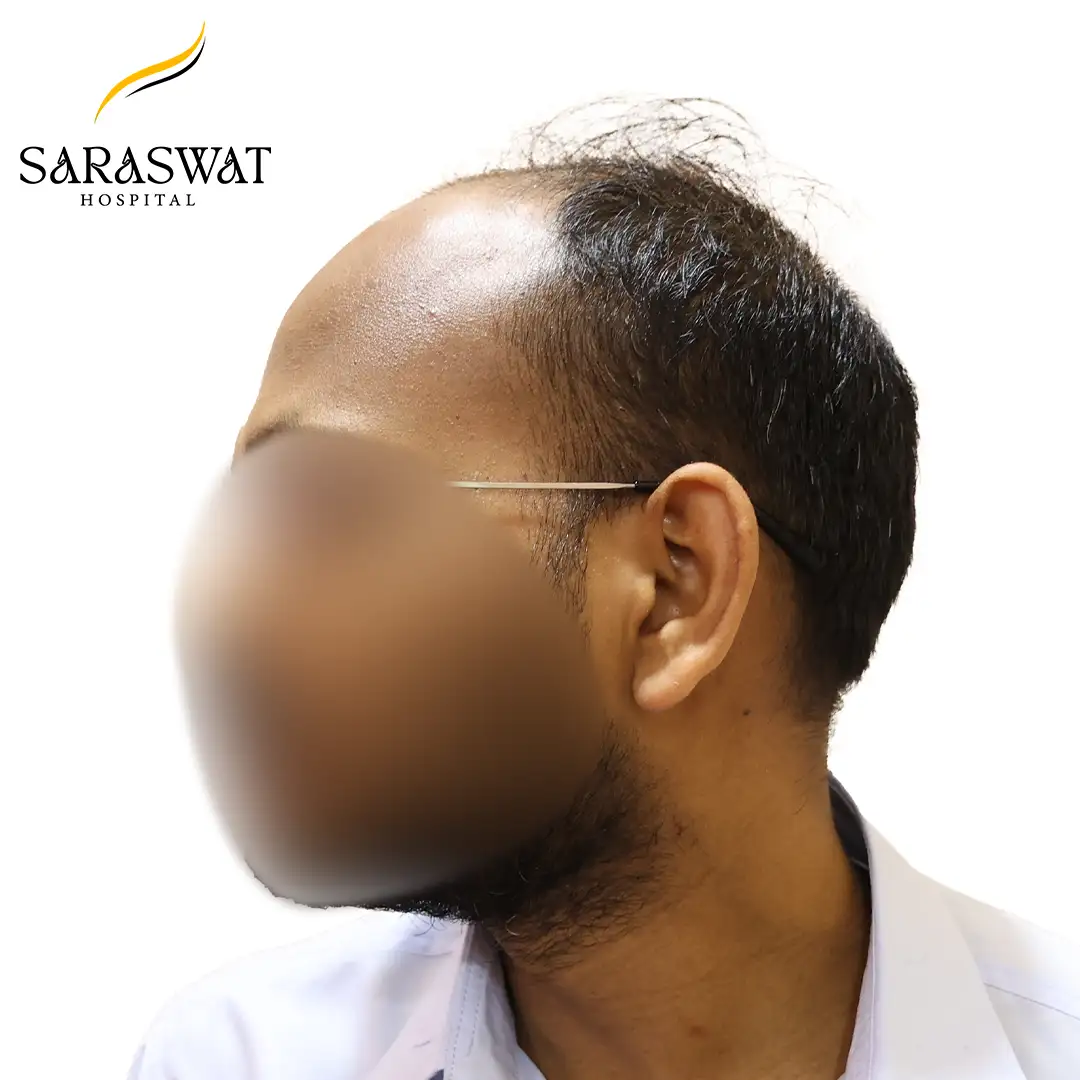 Hair Transplant Before and After Results