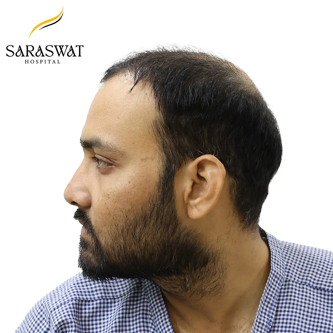 90 Degree Left FUE Hair Transplant Result Before Procedure