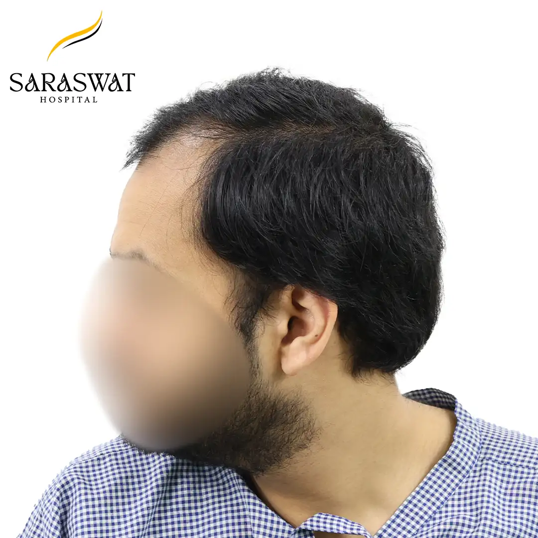 90 Degree Left FUE Hair Transplant Result Before Procedure