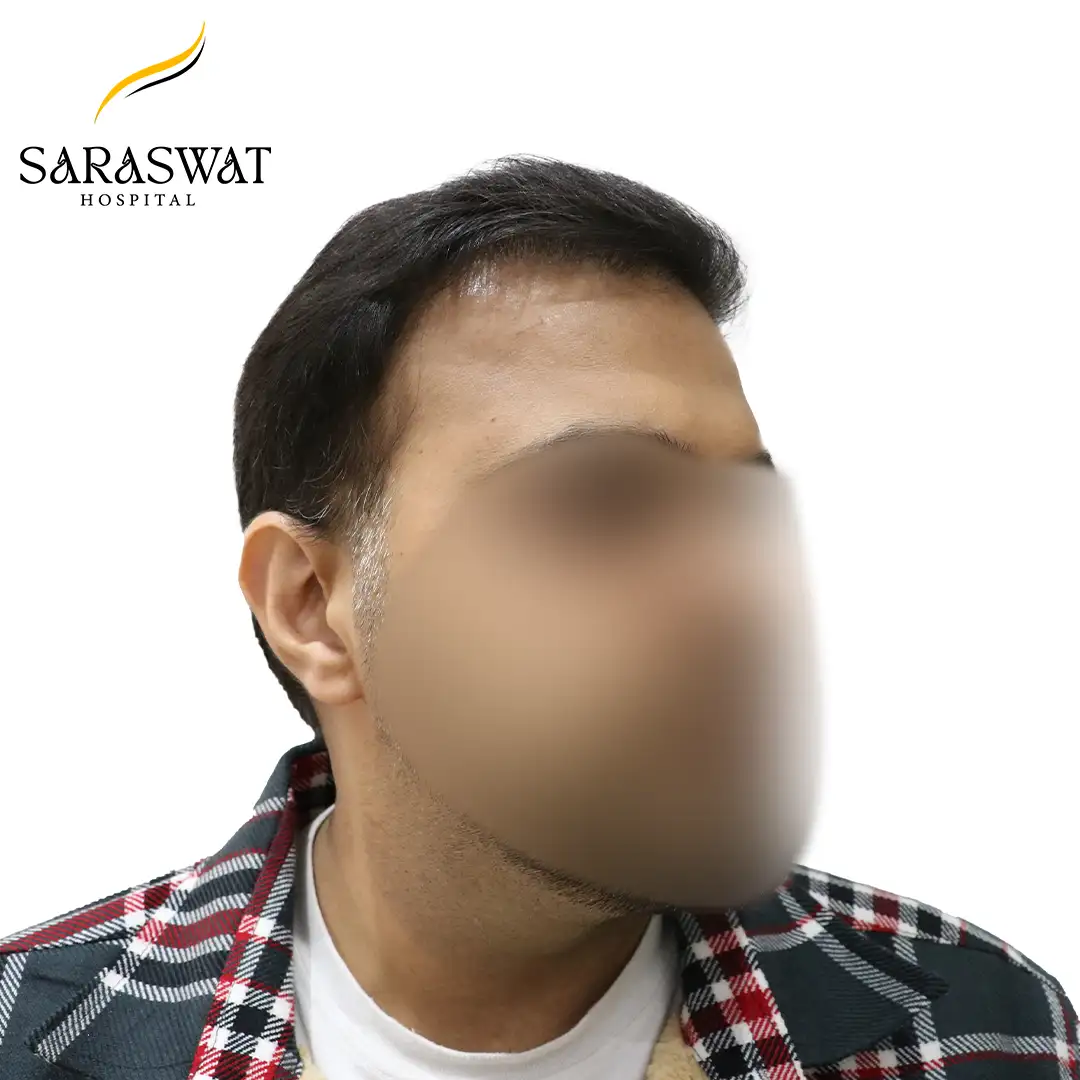 Hair Transplant Result