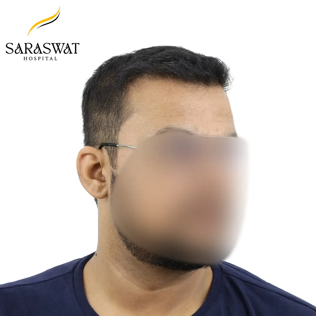 45 Degree Right FUE Hair Transplant Result After Procedure