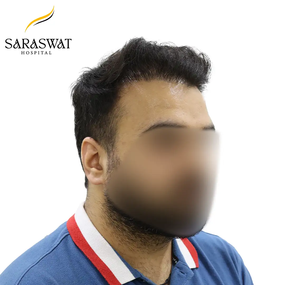 45 Degree Right FUE Hair Transplant Result After Procedure