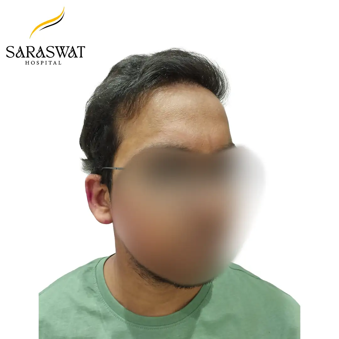 45 Degree Right FUE Hair Transplant Result After Procedure