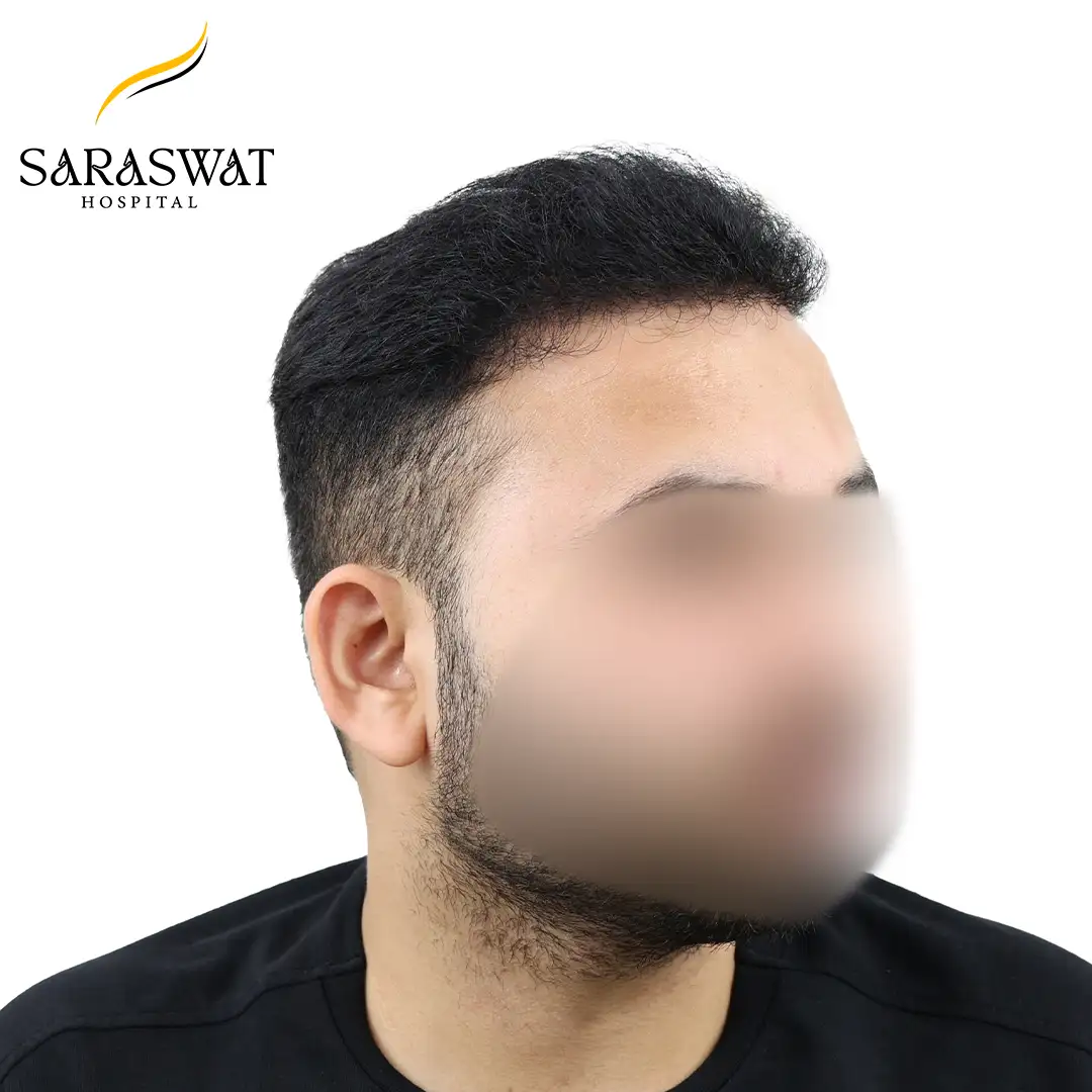 Hair Transplant Before After