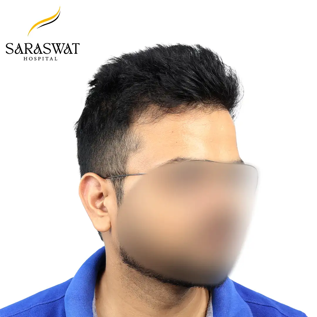 45 Degree Right FUE Hair Transplant Result After Procedure