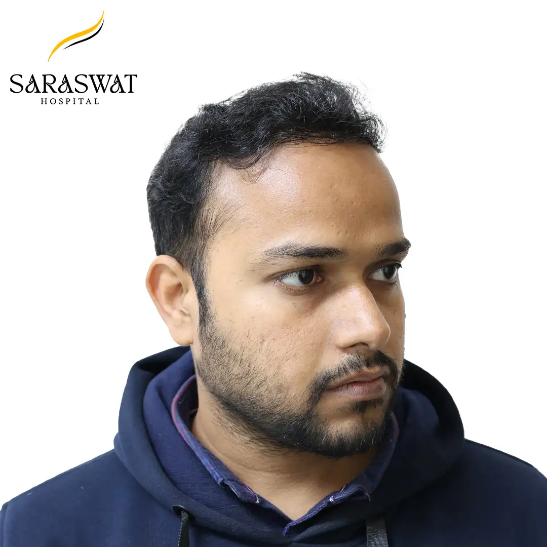 45 Degree Right FUE Hair Transplant Result After Procedure