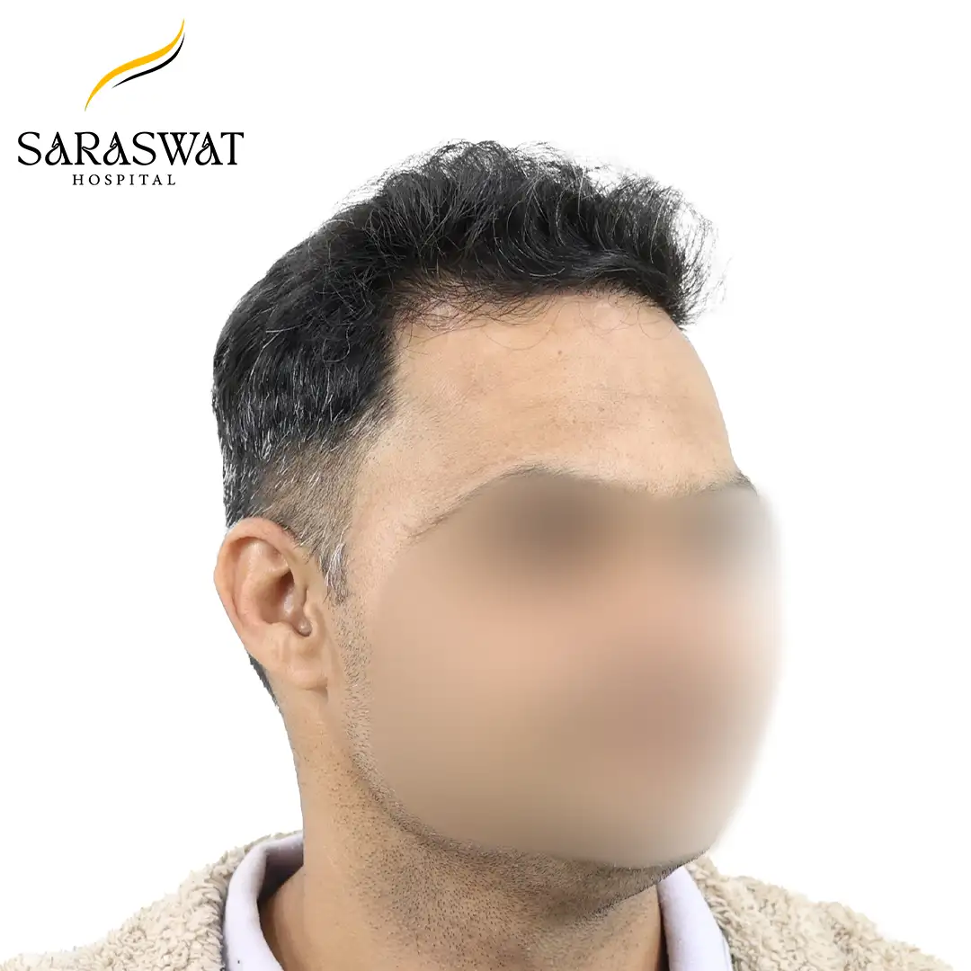45 Degree Right FUE Hair Transplant Result After Procedure