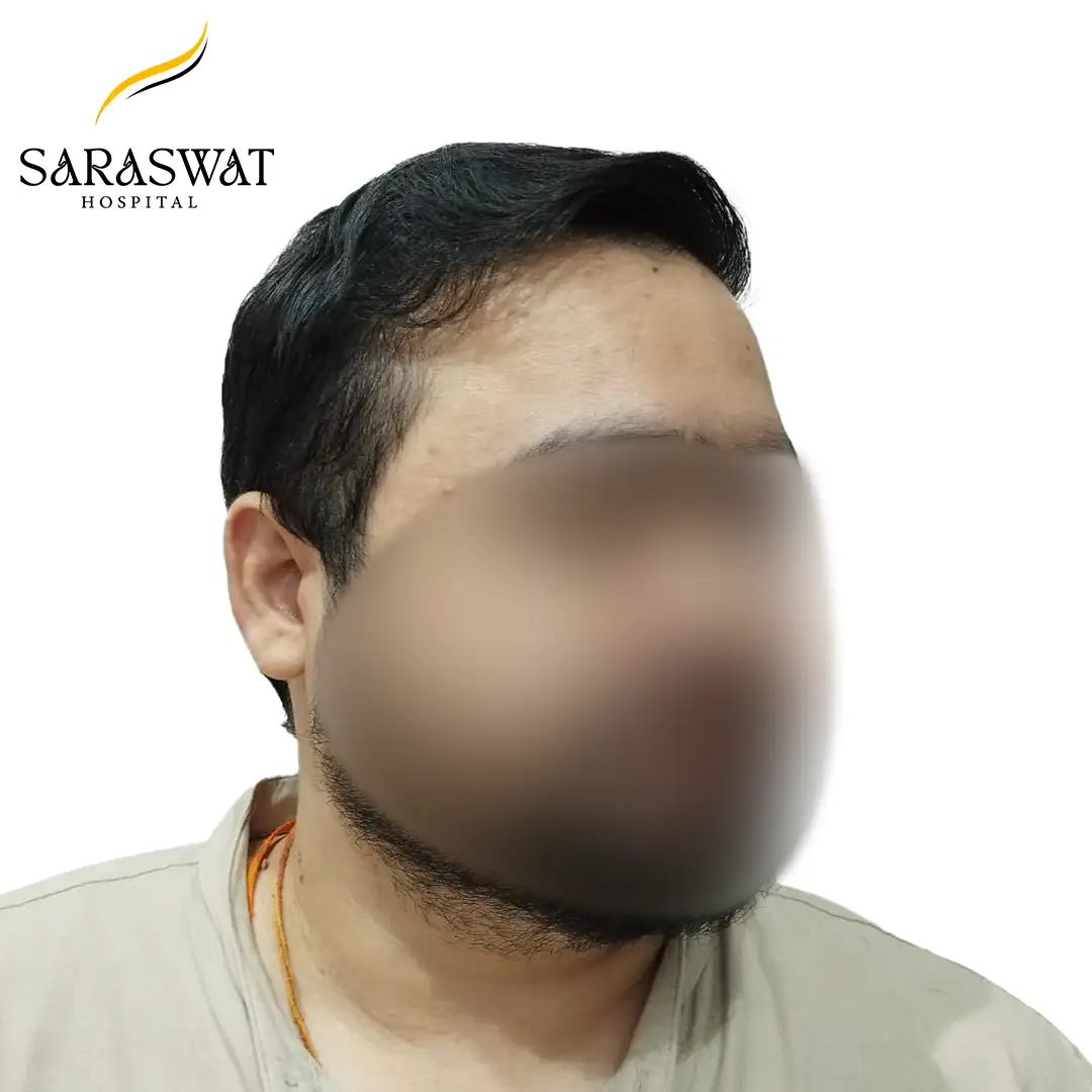 45 Degree Right FUE Hair Transplant Result After Procedure