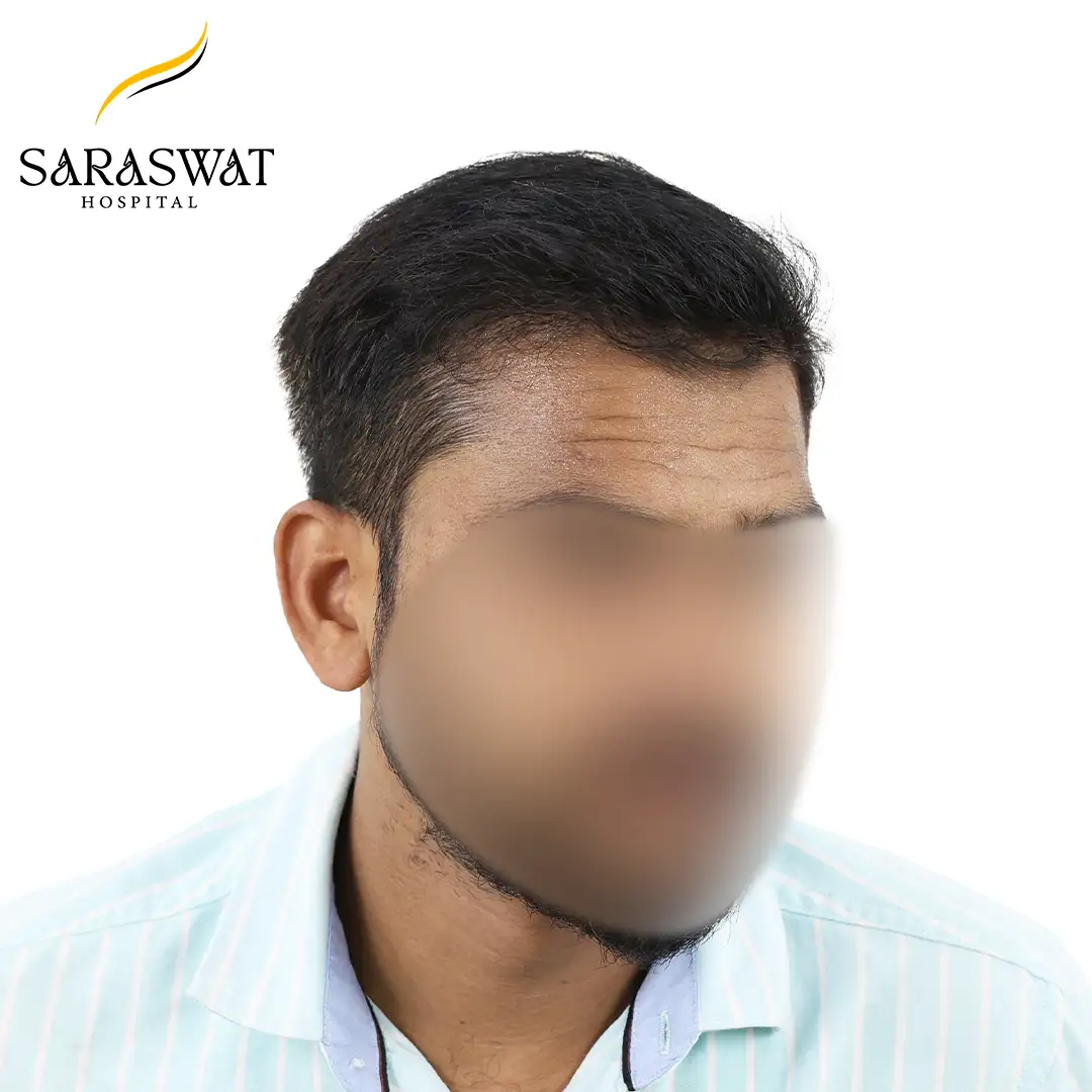 45 Degree Right FUE Hair Transplant Result After Procedure