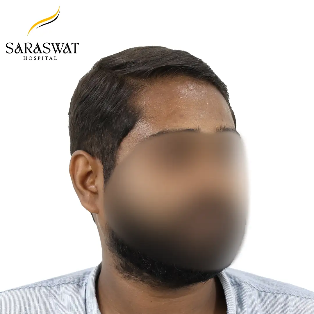 45 Degree Right FUE Hair Transplant Result After Procedure