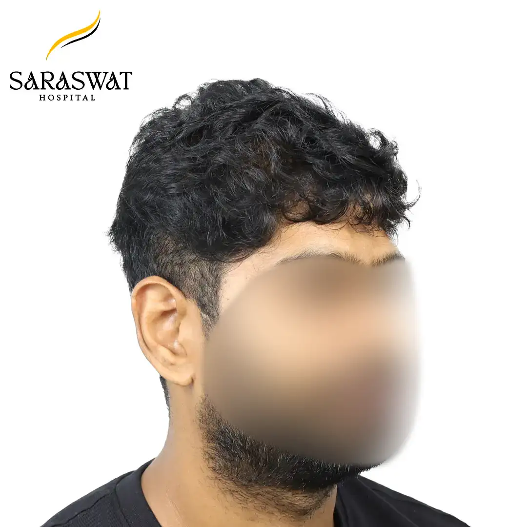 90 Degree FUE Hair Transplant Result After Procedure